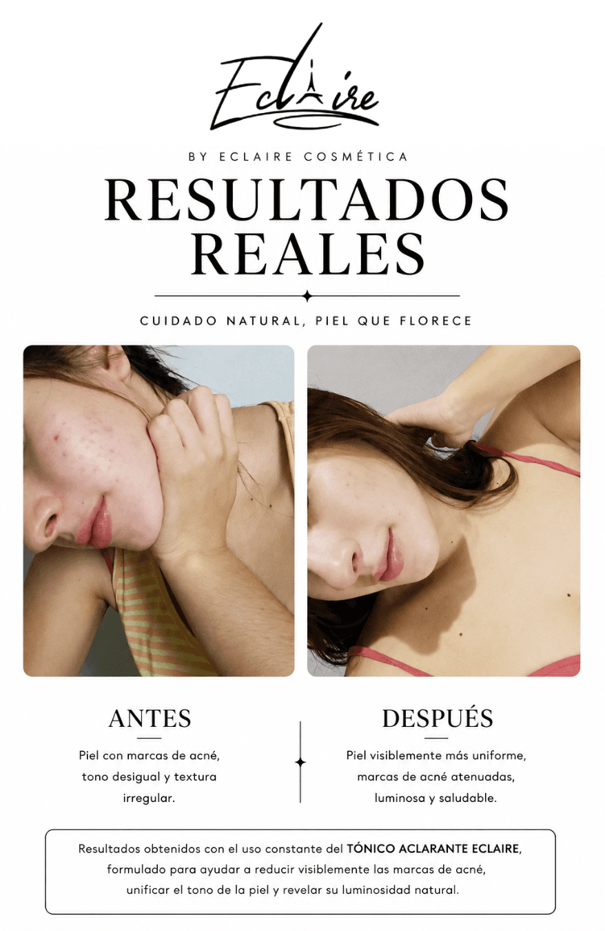 Comparación antes y después del uso del Tónico Aclarante: piel con marcas de acné y piel más uniforme